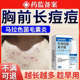 胸前前胸后背长痘痘毛囊炎背上胸口背后马拉色菌药房款膏喷雾剂JW