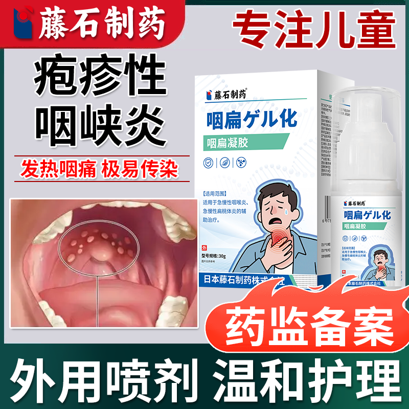 儿童疱疹性咽峡炎成人口腔炎喷雾剂慢性咽炎水泡疹病毒性咽喉炎OZ