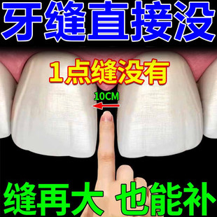 牙缝宽大修复神器门牙缝隙大矫正吃饭塞牙矫正牙齿缝隙填充剂牙膏