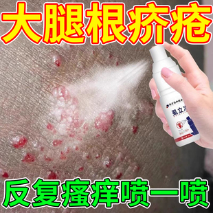 疥疮结节喷雾大腿根疥苍膏硫磺软膏除疥螨虫药监备案KD