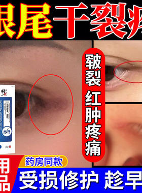 眼角发炎干裂红肿痒皮癣睛