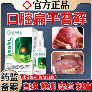 口腔扁平苔藓用药治疗黏膜修复纤维化溃疡药白斑修复液喷剂专 LL