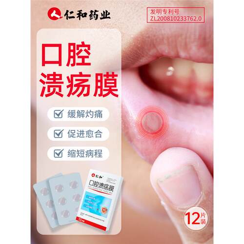 口腔溃疡贴膜疮专用嘴