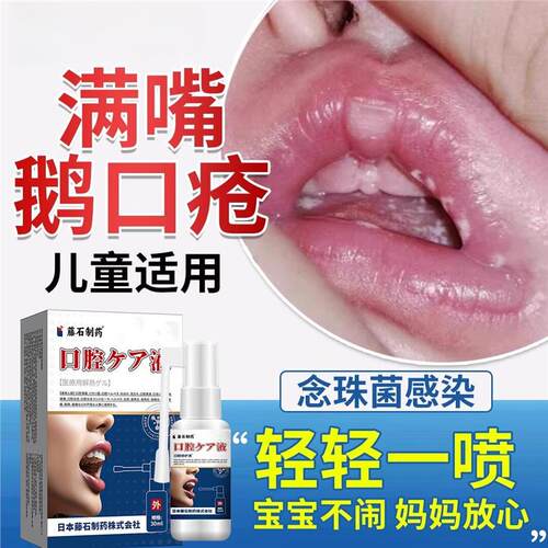 儿童鹅口疮喷剂可搭碳酸氢