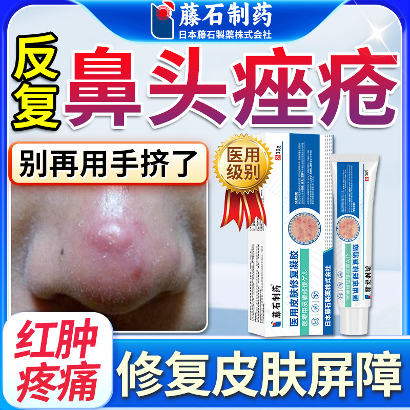 鼻子头上长痘痘鼻头鼻尖红肿火疖子毛囊炎肉疙瘩长脓包型去的尖QY