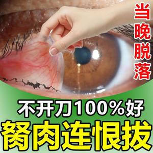 去除眼睛胬肉滴眼液眼睛长胬肉有异物感模糊看不清翼状胬肉眼药水