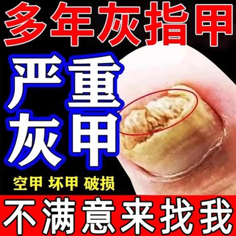 香港大药房官方正品盐酸阿莫洛芬罗芬搽剂灰指甲净亮甲乳膏旗舰店