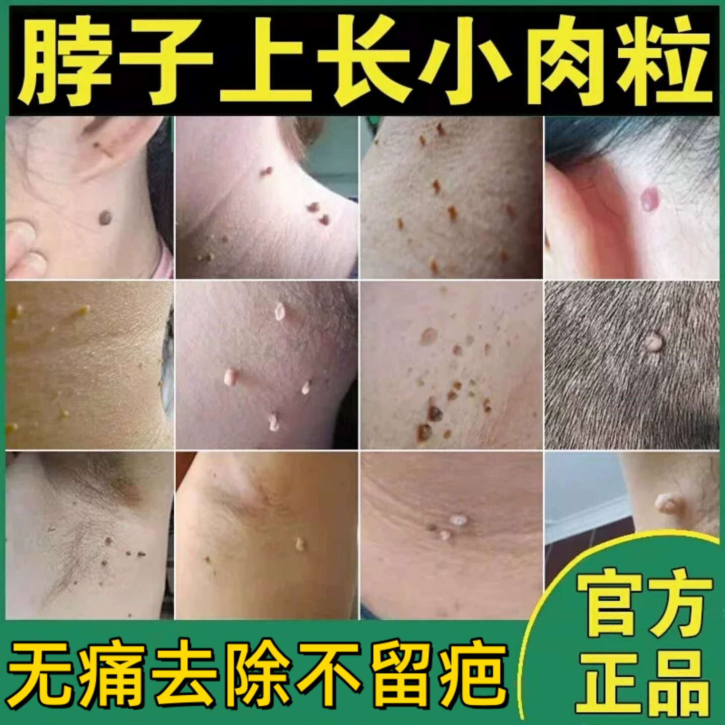 扁平尤瘊子去除喷剂面部一抹灵去脖子上专长小肉粒丝状尤用点疣液
