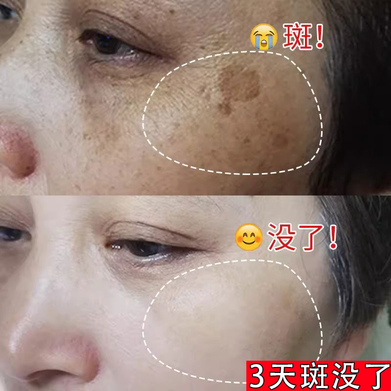 【小红书推荐】祛脸上黑点斑点 斑迹 脸上干干净净 跟斑点说拜拜~