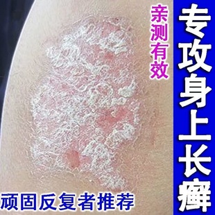 香港牛藓王治疗牛皮藓癣皮炎银屑专用膏头皮去屑皮肤症效痒特正品