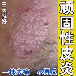 皮肤湿痒止疹去顽固根外用慢性皮炎植物草本拔疹灵抑菌皮肤止痒膏