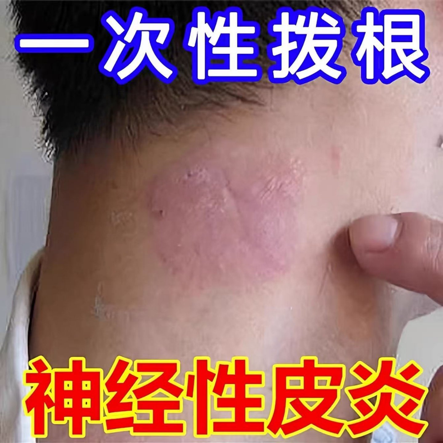 治疗神经性皮炎【仅需一次】