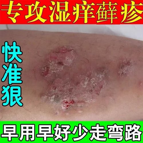 治疗神经性皮炎【仅需一次】