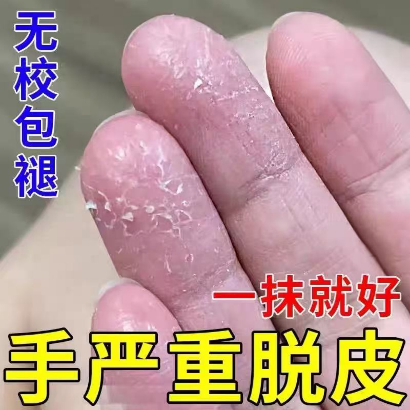 手足脱皮膏【当天告别掉皮】