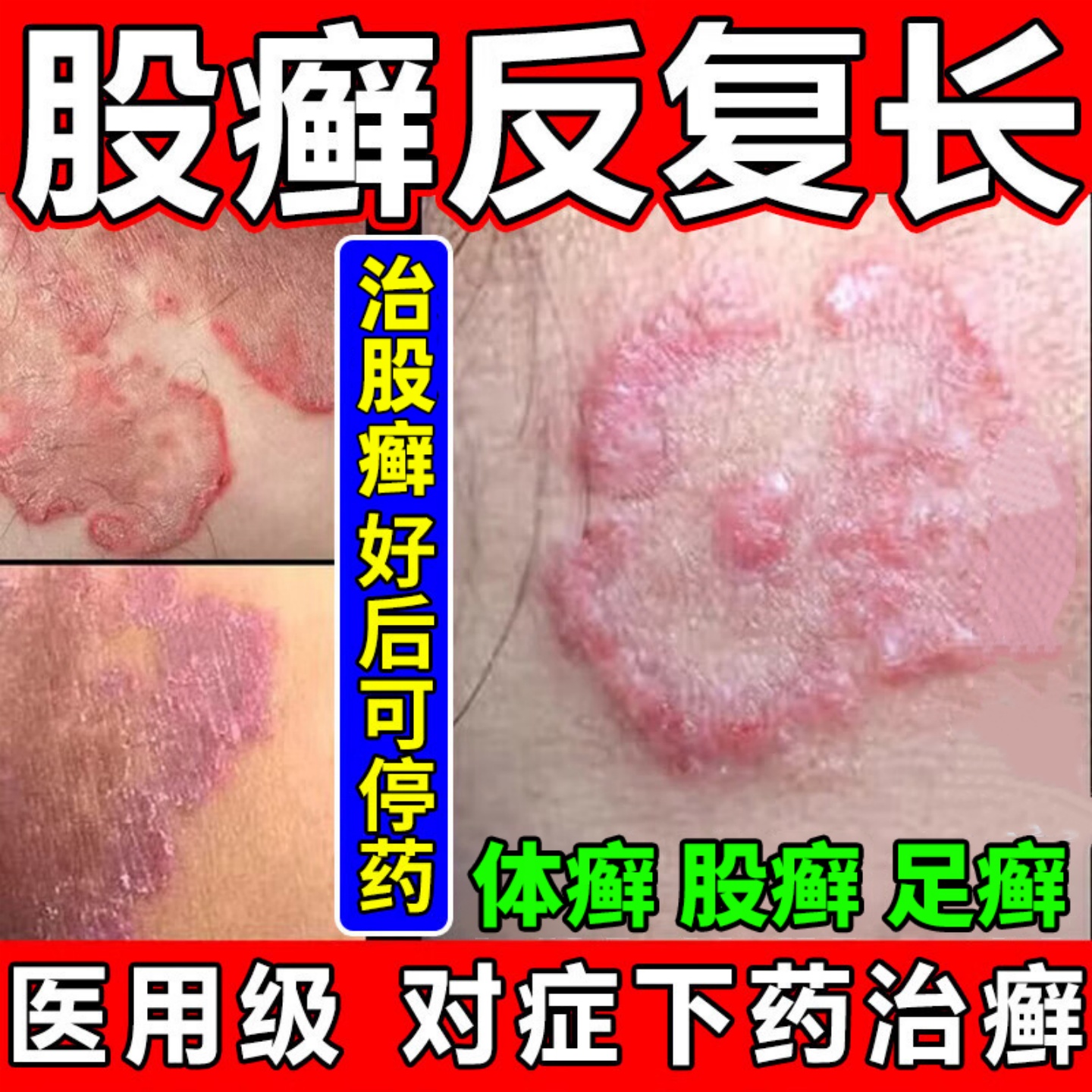大腿内侧瘙痒【救星膏】