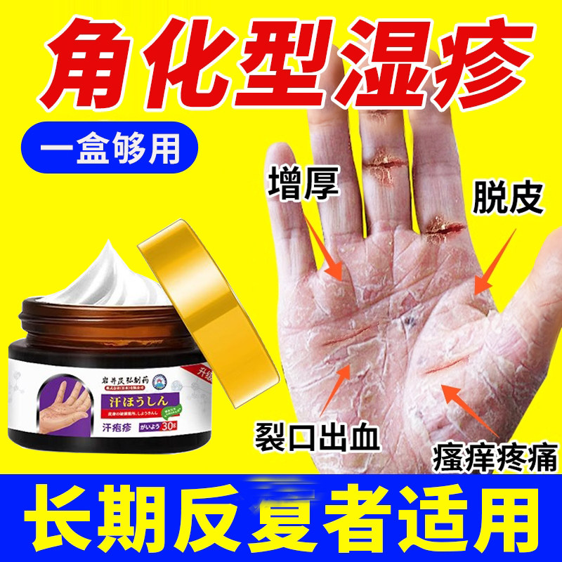 日本手指腹角化型湿疹手癣膏脱皮干裂真菌感染慢性角质化皲裂性手