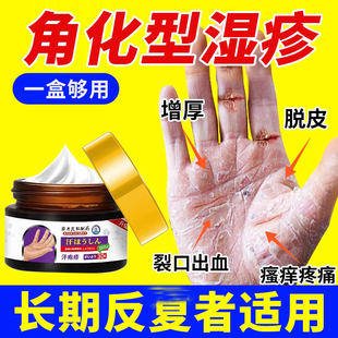 日本手指腹角化型湿疹手癣膏脱皮干裂真菌感染慢性角质化皲裂性手
