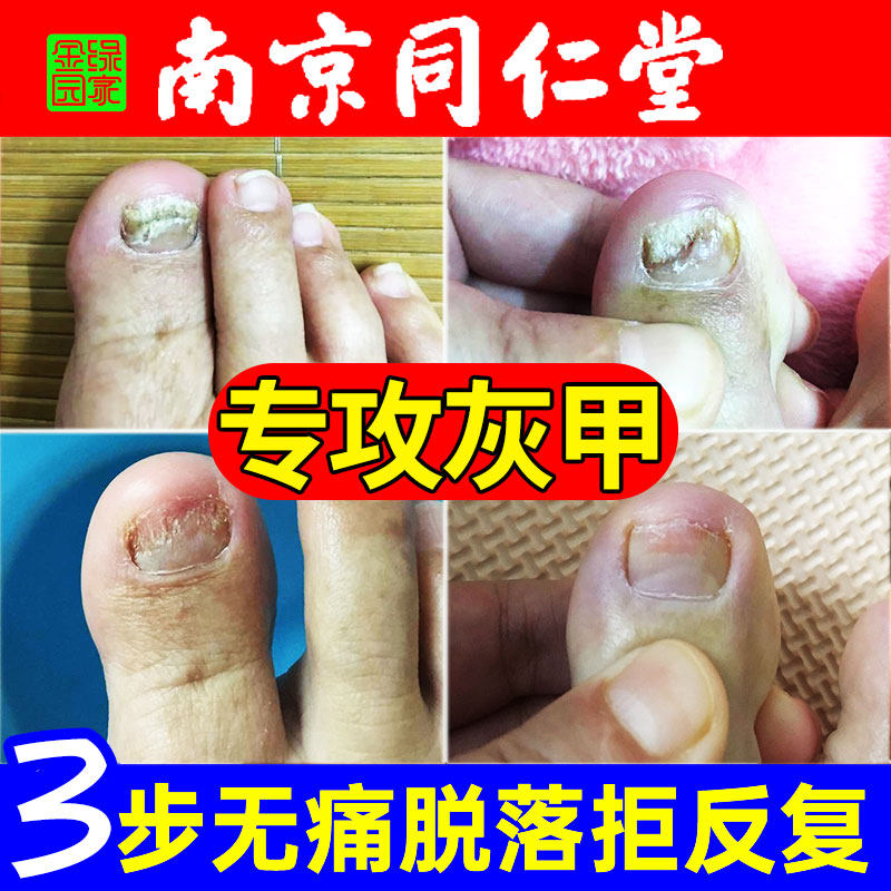 灰指甲治疗膏药贴正品甲癣真菌感染根剪指刀治指甲刀专用旗舰店TF
