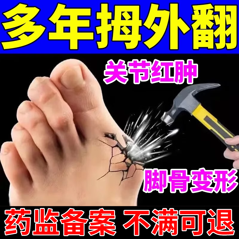 拇指外翻拇外翻药膏贴女士大脚骨矫正器拇囊炎大脚母疼痛膏药贴DZ