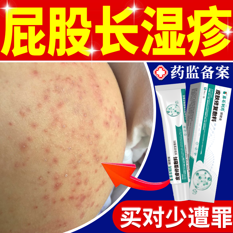 【保密速发】专研屁股湿疹长痘痘