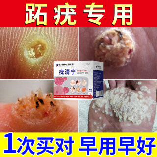 跖疣专用膏去除血胞刺去鸡眼石疣脚底趾疣拓尤必净清尤敷料根DF