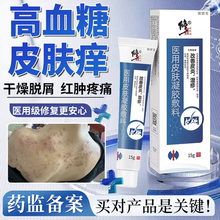 糖尿病皮肤痒腿痒治老年人高血糖止痒专用疗外阴瘙痒药房同款膏EM