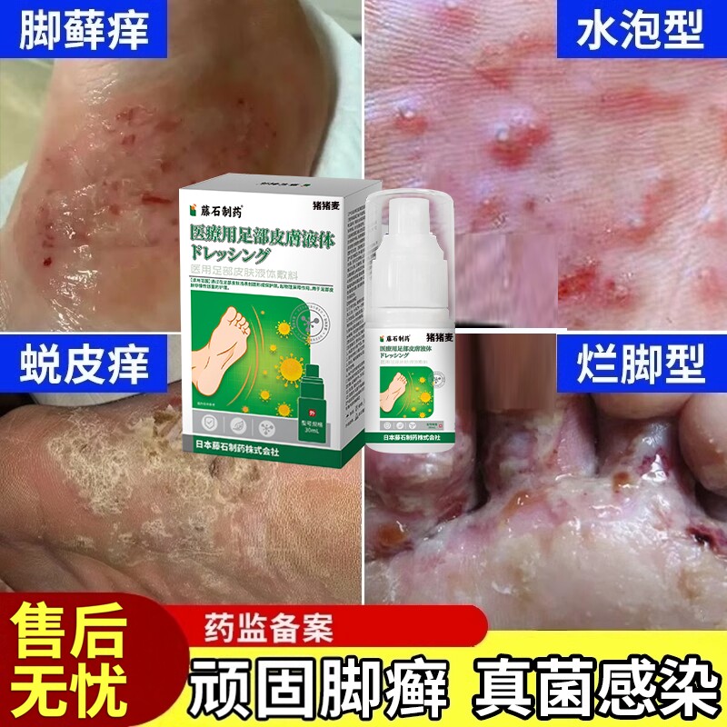 脚癣一次喷雾净足藓专用去糜烂性根止痒脱皮真菌感染薬房同款膏DZ