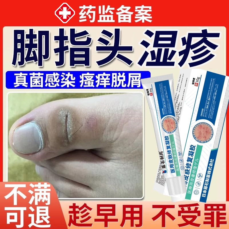 脚趾关节黑痒湿疹膏发黑瘙痒增厚