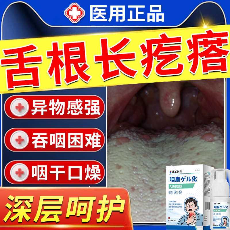 舌根长疙瘩淋巴滤泡性增生咽喉炎慢性咽炎除异物感根舌头上肉粒BS