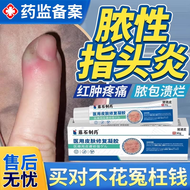 脓性指头炎手指甲内红肿疼溃烂甲沟炎边缘发手指流脓炎消肿化脓EM