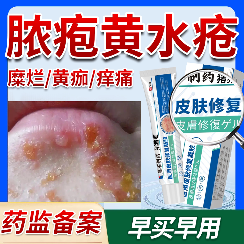 湿疹渗液黄水疮皮肤黄水溃疡止痒皮炎疱疹结痂一扫光药房同款膏OZ