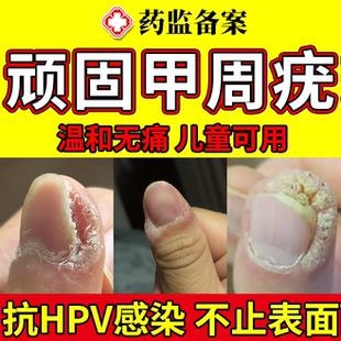 甲周疣专用hpv去疣硬皮手上长硬疙瘩可搭寻常疣薬膏甲下手指疣JW