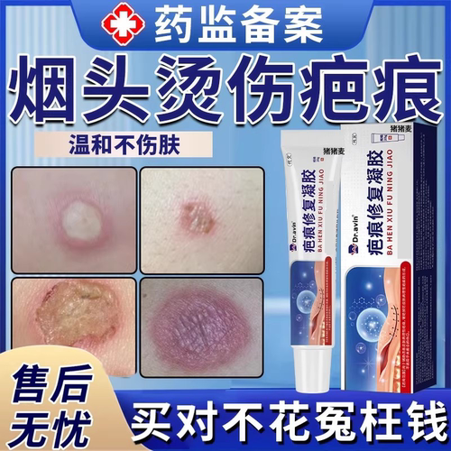 【疤痕修复凝胶】烟头烫伤疤痕