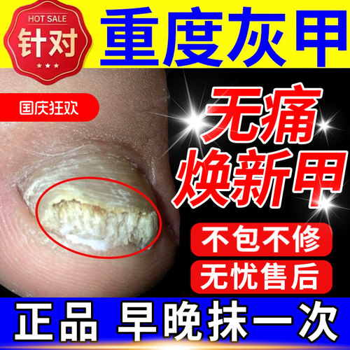 荷兰医研专攻灰指甲【无效包退】