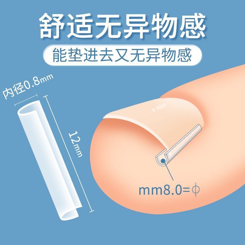 甲沟神器指甲矫正器嵌甲专用