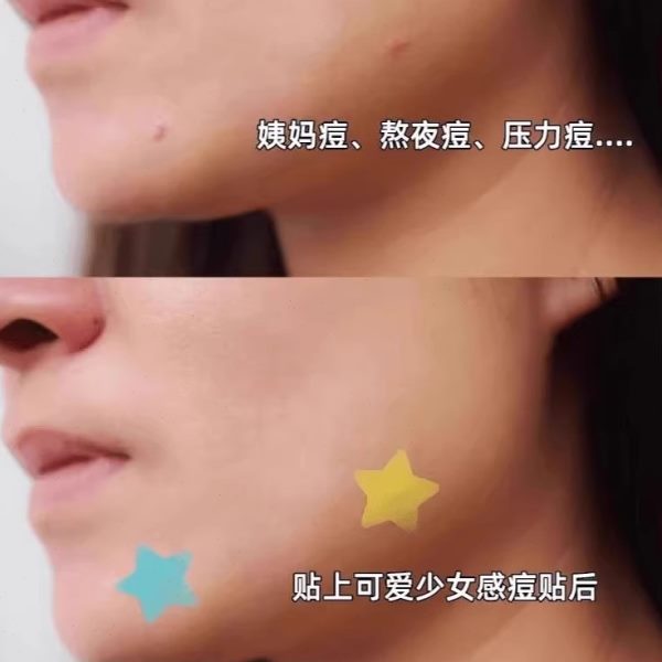 舒缓单】50胶 痘痘贴遮瑕外出水星星_Y0组合装防水体立减8【下贴