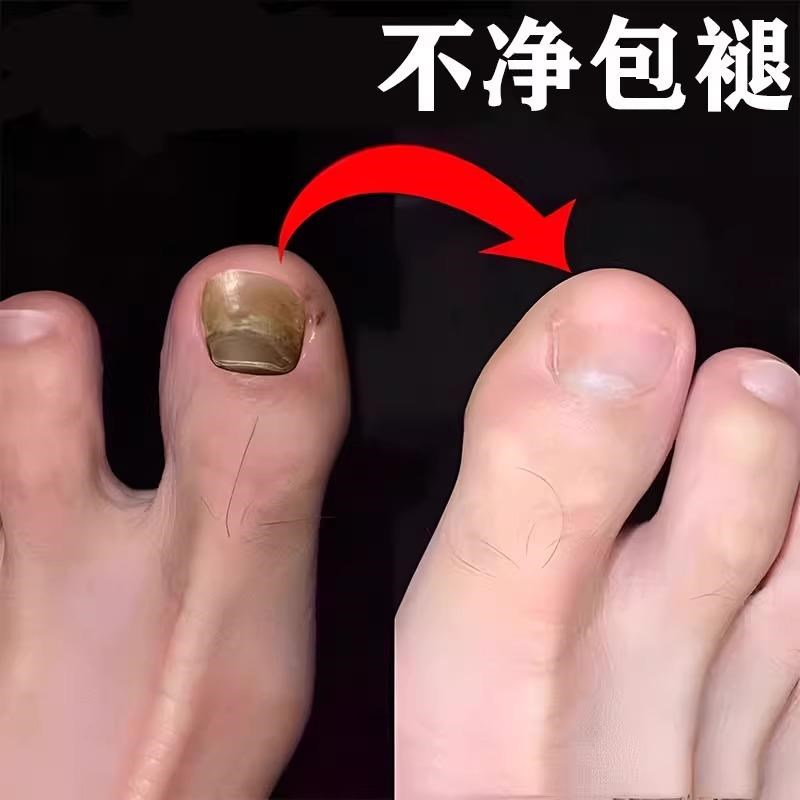 【同仁堂热卖10万+】不包不修 滴一滴无痛去除手脚趾坏钾不伤好钾