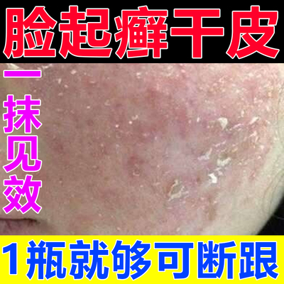 脸上起癣长癣眼皮癣脸部皮肤干燥起皮有碎屑除过敏红痒癣修复男士