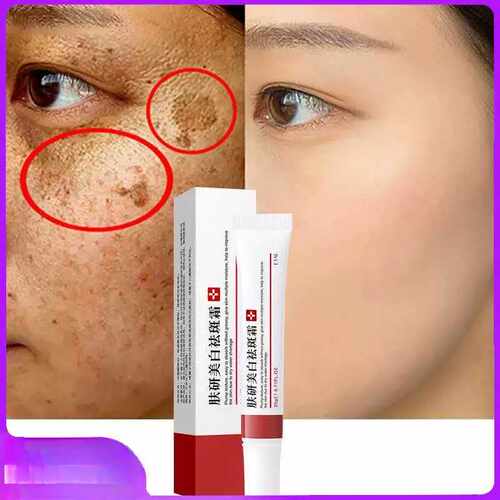 Whitening Freckle Cream Remove Melasma Cream Remove Dark Spo