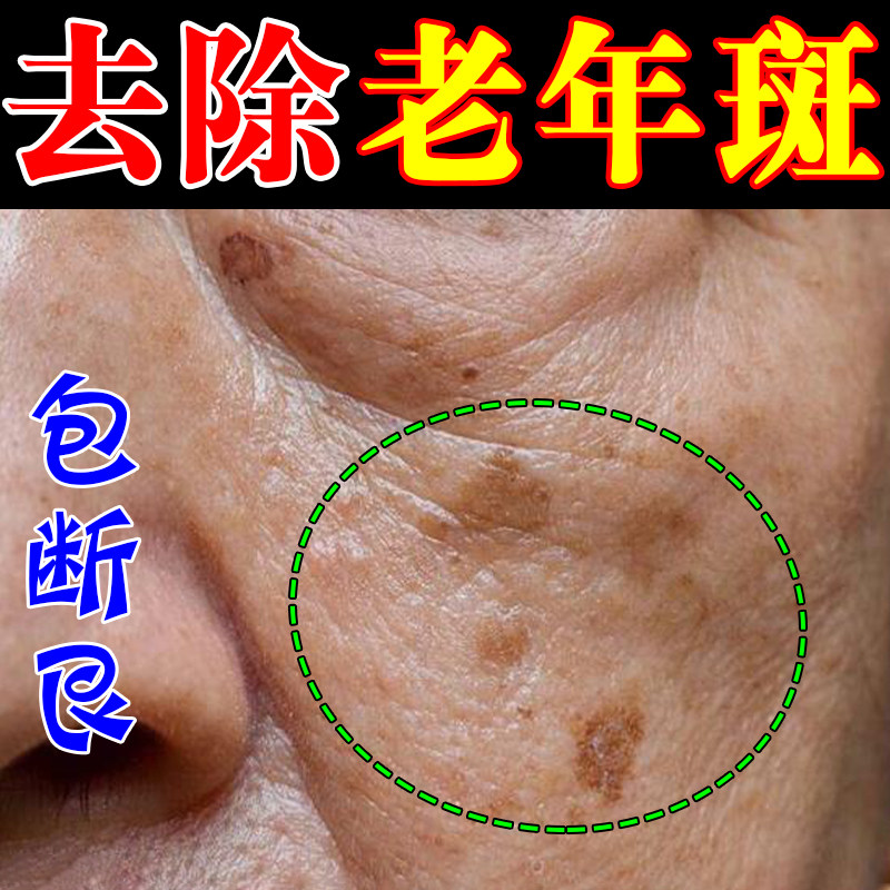 去斑霜专治老年斑点老年斑药水不留疤黑班点手部脸部黄褐斑晒斑
