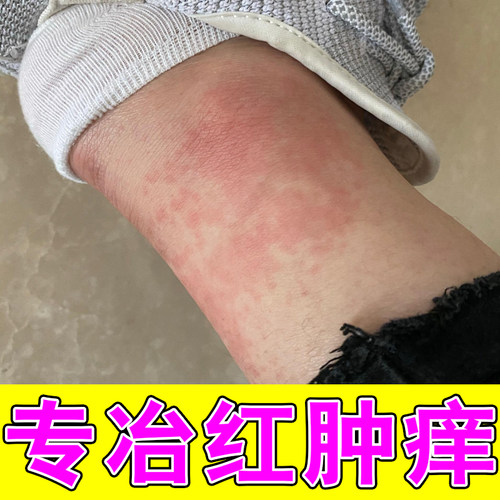 专冶脚脖子红肿红斑皮肤长红点痒感染过了个敏外用软膏