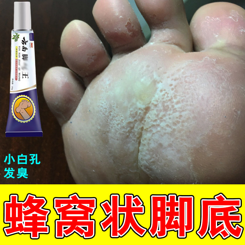 窝状角质松解懈症专用感染水泡出皮肤消毒护理（消）