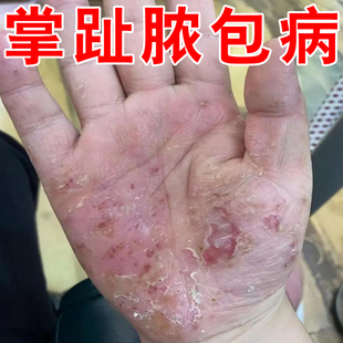 掌趾脓疱病掌跖脓包角化病症手脚脱皮干裂角皮症专用