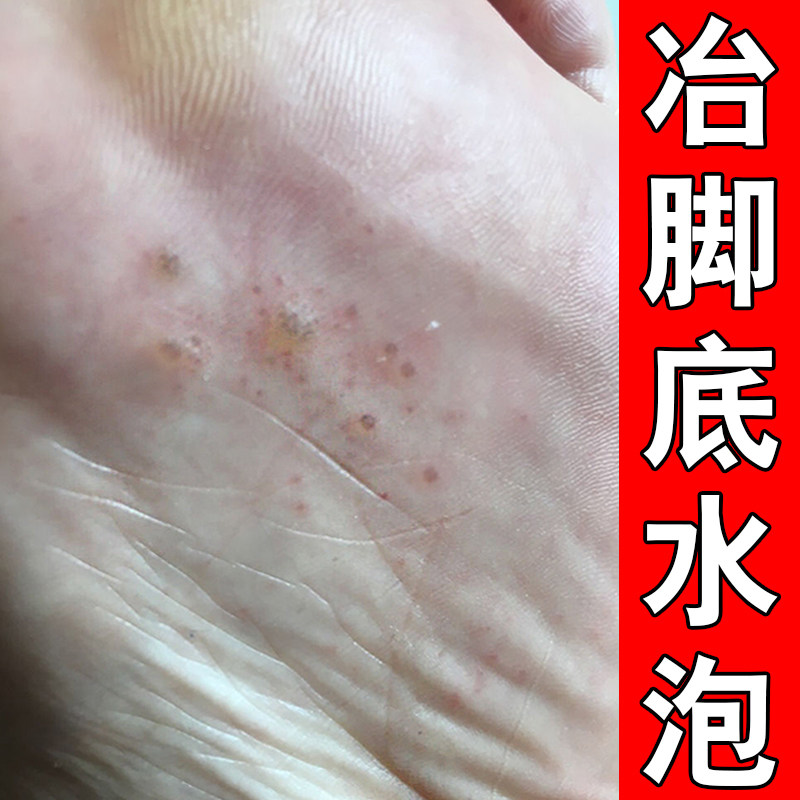 脚心痒脱脚皮脚底起小水泡又痒又皮肤消毒护理（消）