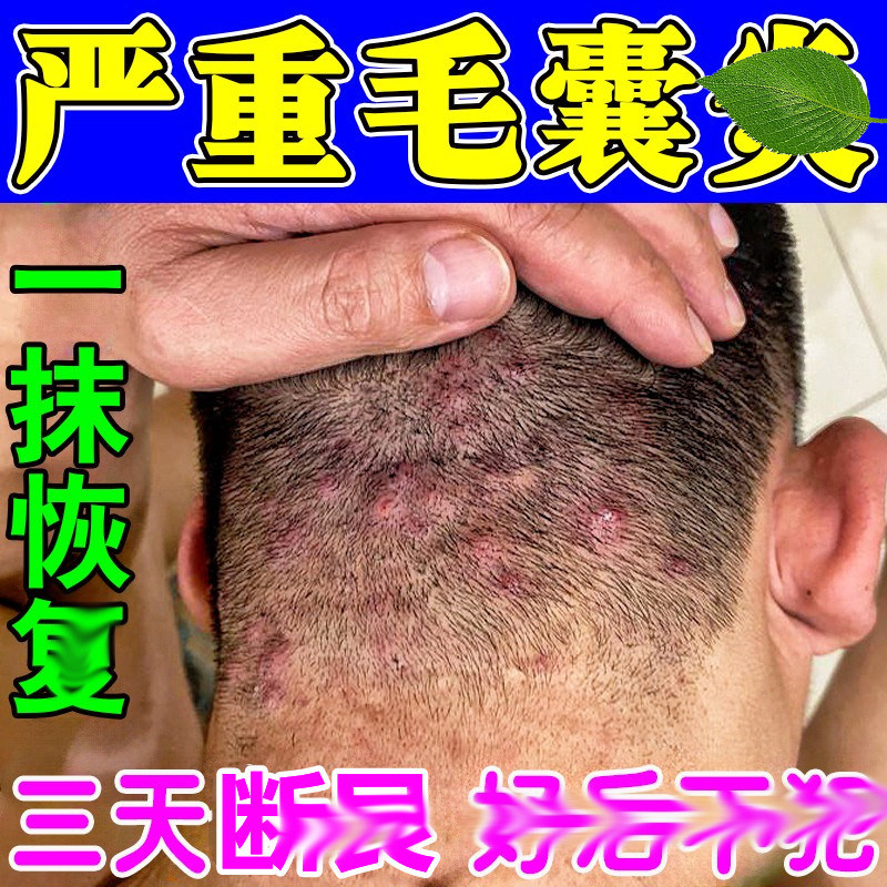 头皮毛囊特校膏专用头上红疙瘩脓包红肿痒疼软膏