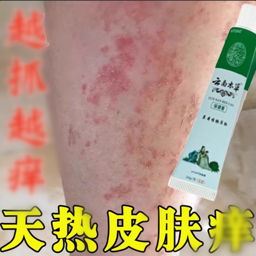 夏天热出汗小腿痒成人用软膏出汗身上痒天热腿上红肿皮肤疙瘩粗糙