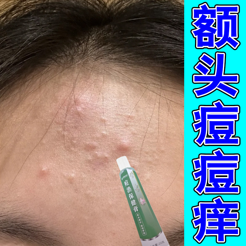额头痘痘内调药去青春痘男女学生头部长红肿痘痘闭口粉刺小疙瘩膏