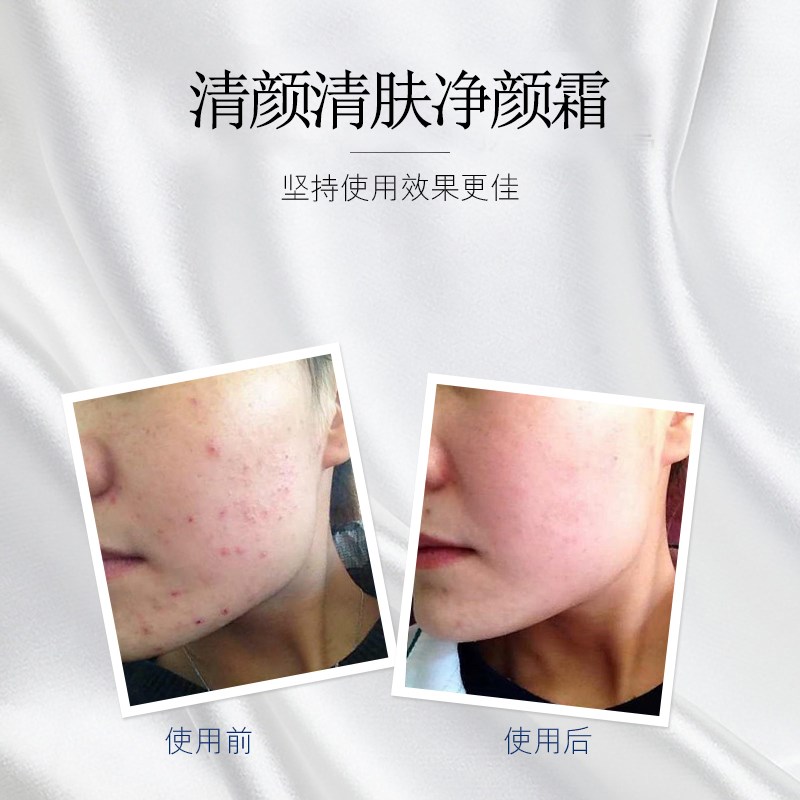 清颜祛痘膏正品祛痘印痘坑痘疤快速去闭口顽固青春痘粉刺修护面霜