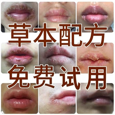 【苗家非遗】专治唇炎口角炎