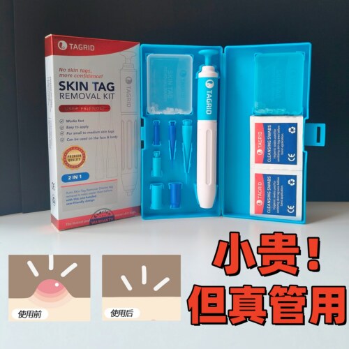 肉瘤疙瘩皮赘肉粒各种疣体去除